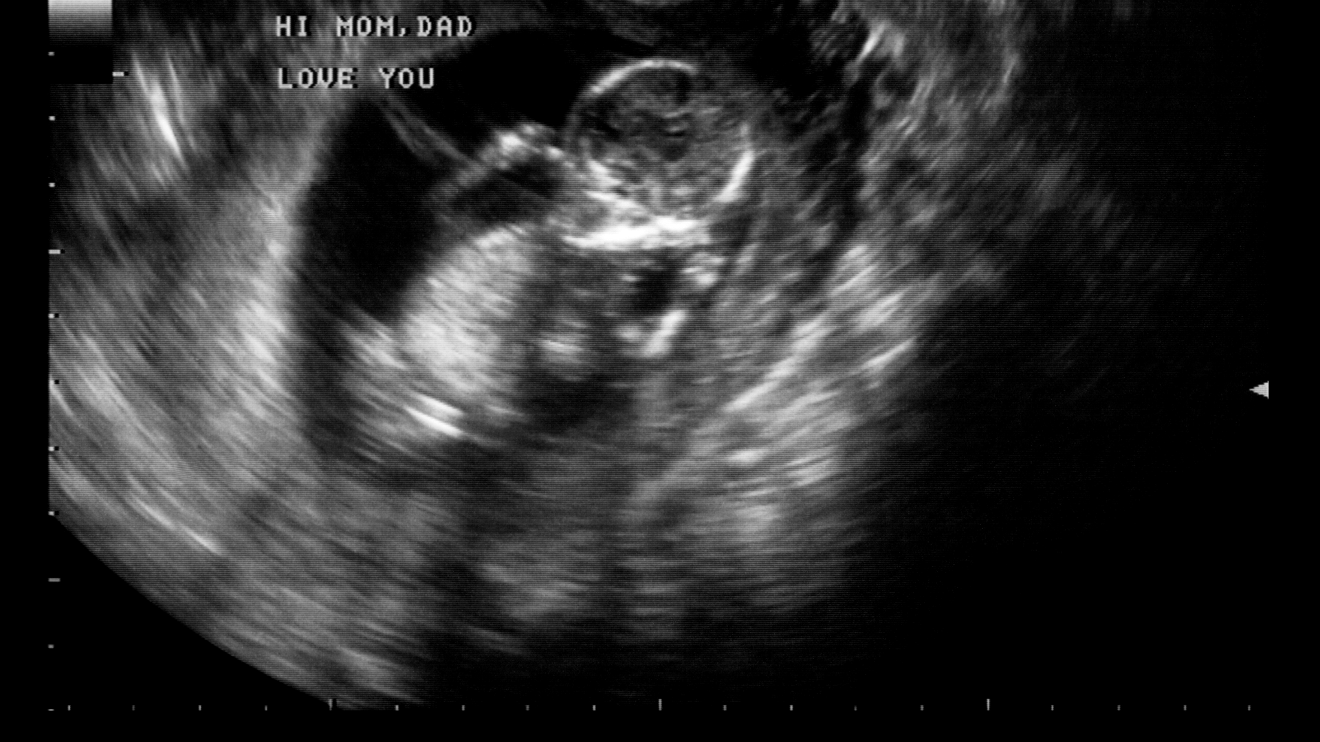 Ultra Sound Scan